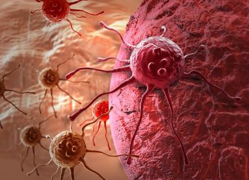 האבחנה נשכחה במגירה – הסרטן התפשט בגוף